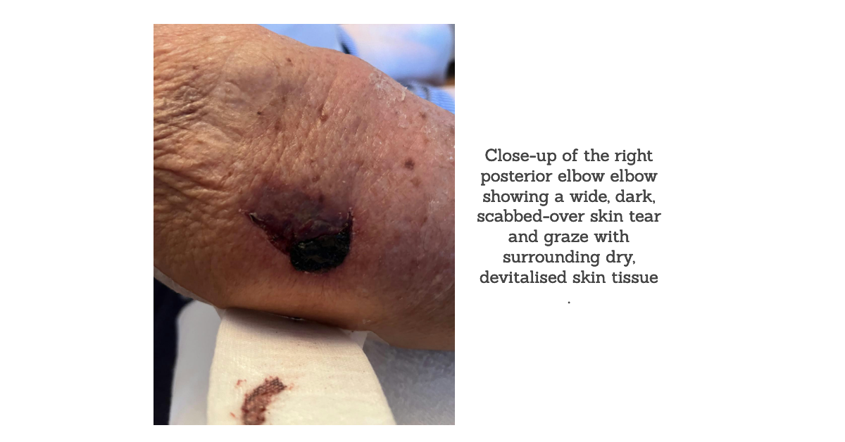 Close-up of the right posterior elbow elbow showing a wide, dark, scabbed-over skin tear and graze with surrounding dry, devitalised skin tissue .
